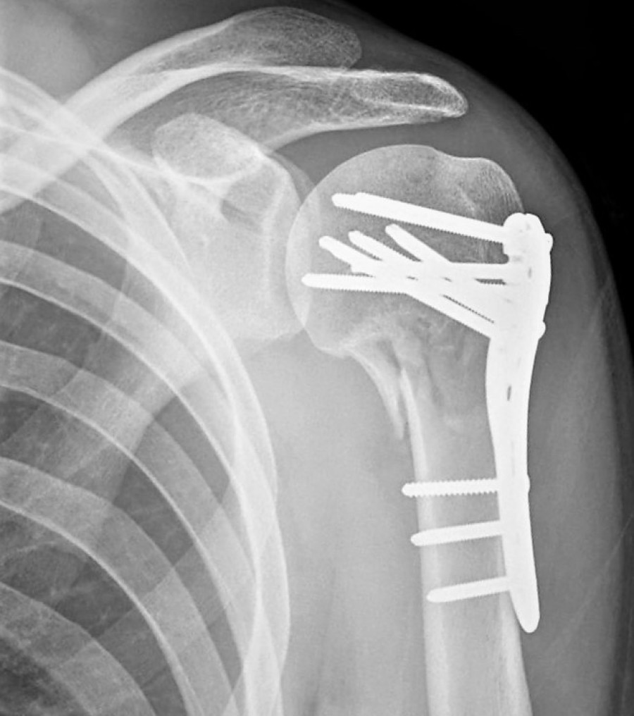 Plymouth Shoulder and Elbow Surgery