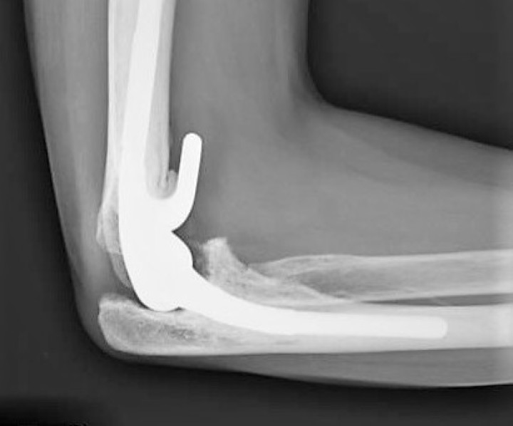 Elbow Replacement